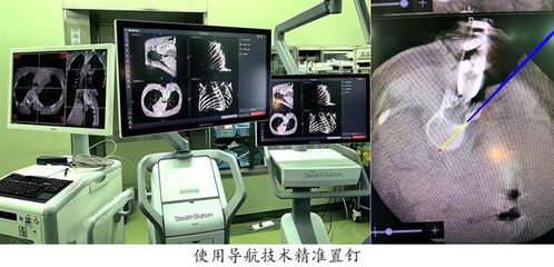 导航系统助儿童脊柱手术更精准 复旦儿科暑期手术刷新记录